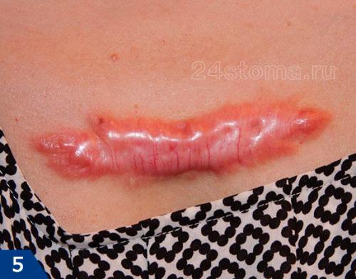 Самое лучшее средство от шрамов после прыщей. Виды шрамов (рубцов)  –