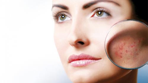 Как избавиться от шрамов после прыщей. Как убрать рубцы от прыщей на лице? 04