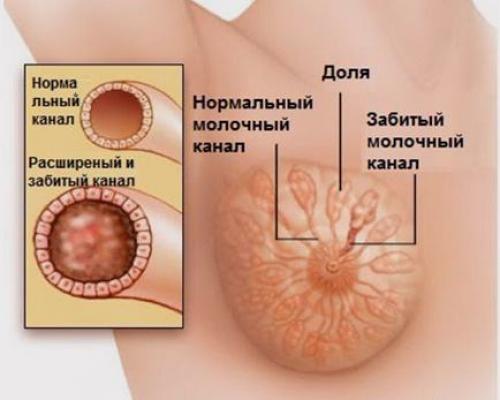 Лимфодренажный массаж грудное вскармливание. Чтобы справиться с нагрубанием, необходимо предпринять следующие действия: 05 Лимфодренажный массаж грудное вскармливание. Чтобы справиться с нагрубанием, необходимо предпринять следующие действия: 05