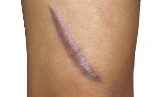 Как убрать рубцы на лице. От чего зависит тип рубца?