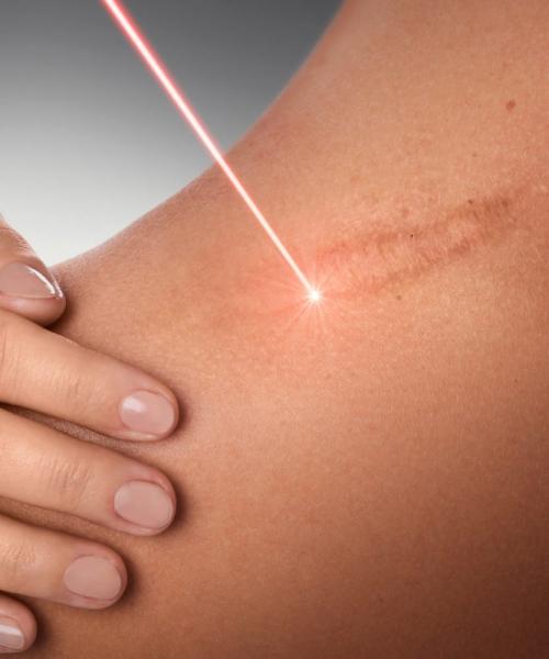 Рубцы и шрамы от прыщей на лице. Как убрать 01