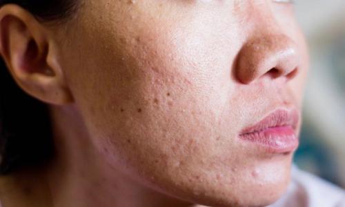 Как избавиться от красных пятен от прыщей. Лечение 01 Как избавиться от красных пятен от прыщей. Лечение 01