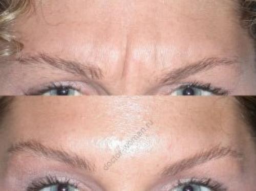 Ботокс лица до и после. Молодость сохранить можно, но есть опасения —, что нас ждет после инъекции ботулотоксина?