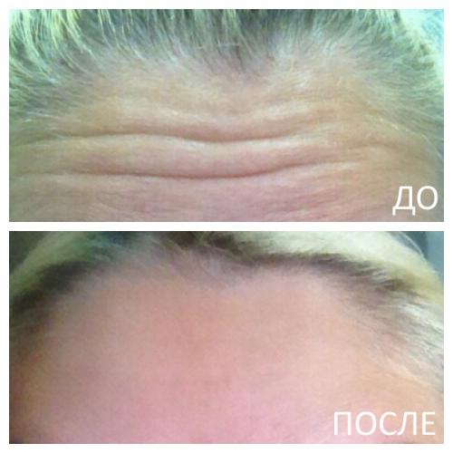 Сколько Ботокса нужно в лоб и межбровье. Процедура введения Ботокса в лоб – просто и быстро! 03