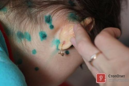 Болит ухо после прокола хряща. Безболезненный пирсинг 12