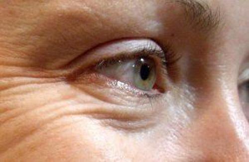 Подходы к устранению морщин под глазами и вокруг глаз 03