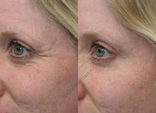 Дряблая кожа после ботокса. Молодость сохранить можно, но есть опасения —, что нас ждет после инъекции ботулотоксина?