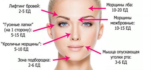 Побочные эффекты после Ботокса 04 Побочные эффекты после Ботокса 04