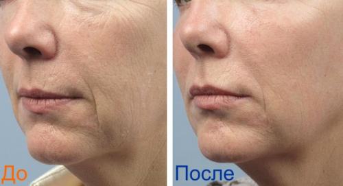 Термолифтинг вокруг глаз. Термолифтинг лица