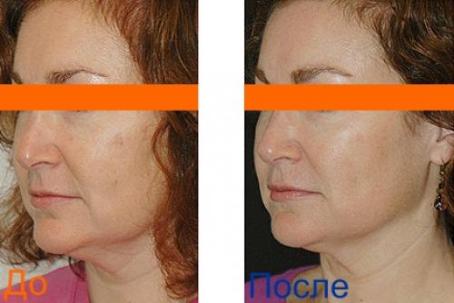 Термолифтинг вокруг глаз. Термолифтинг лица