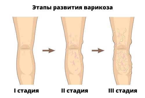Можно ли антицеллюлитный массаж при варикозе. Содержание статьи: 01