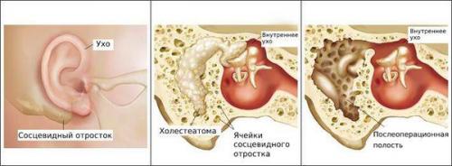 Гноится ухо в месте прокола. Как ухаживать за кожей после пирсинга 01 Гноится ухо в месте прокола. Как ухаживать за кожей после пирсинга 01
